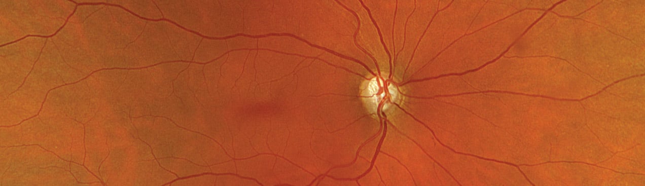 Color rgb with Glaucoma