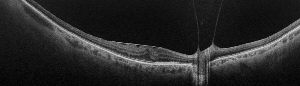 oct image