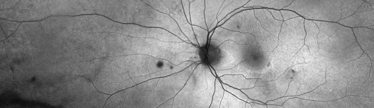 optomap green af Hydroxychloroquine Retinopathy
