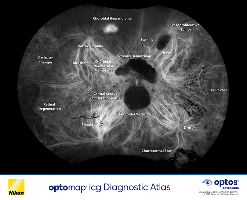 Diagnostic Atlas - optomap icg