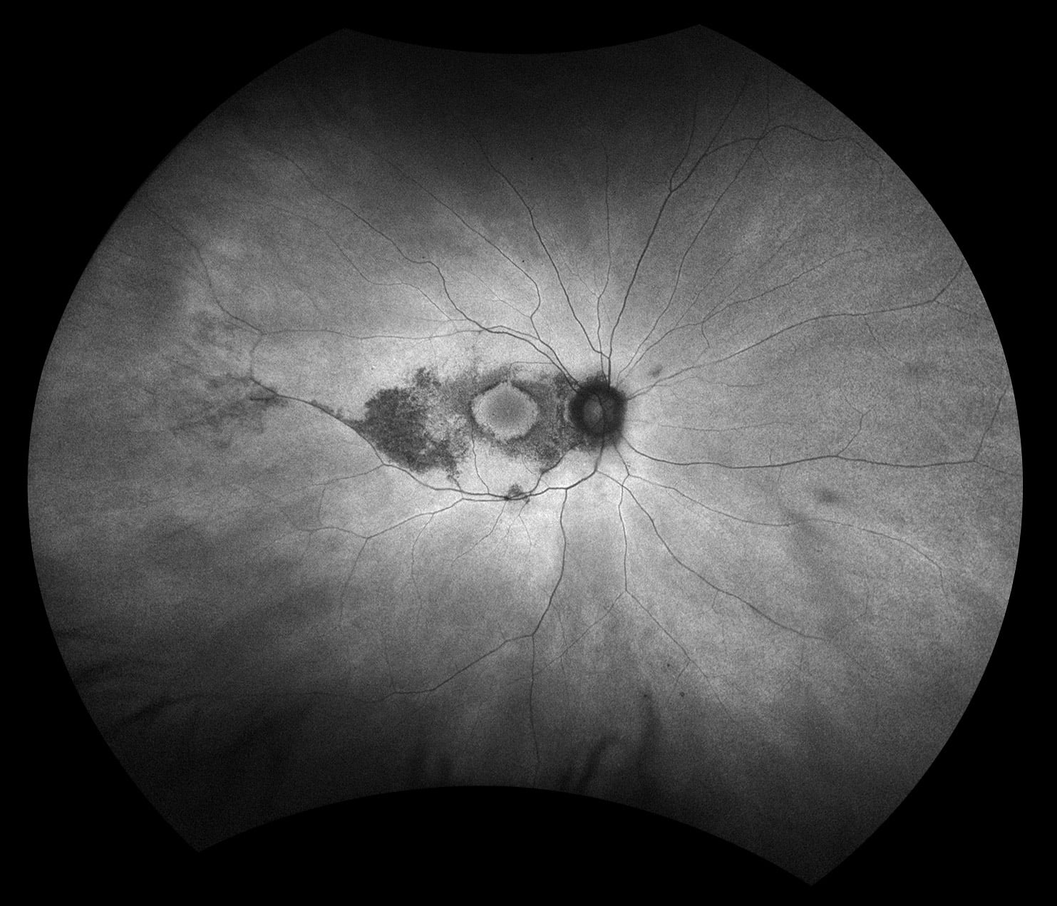 optomap green af Hydroxychloroquine Retinopathy