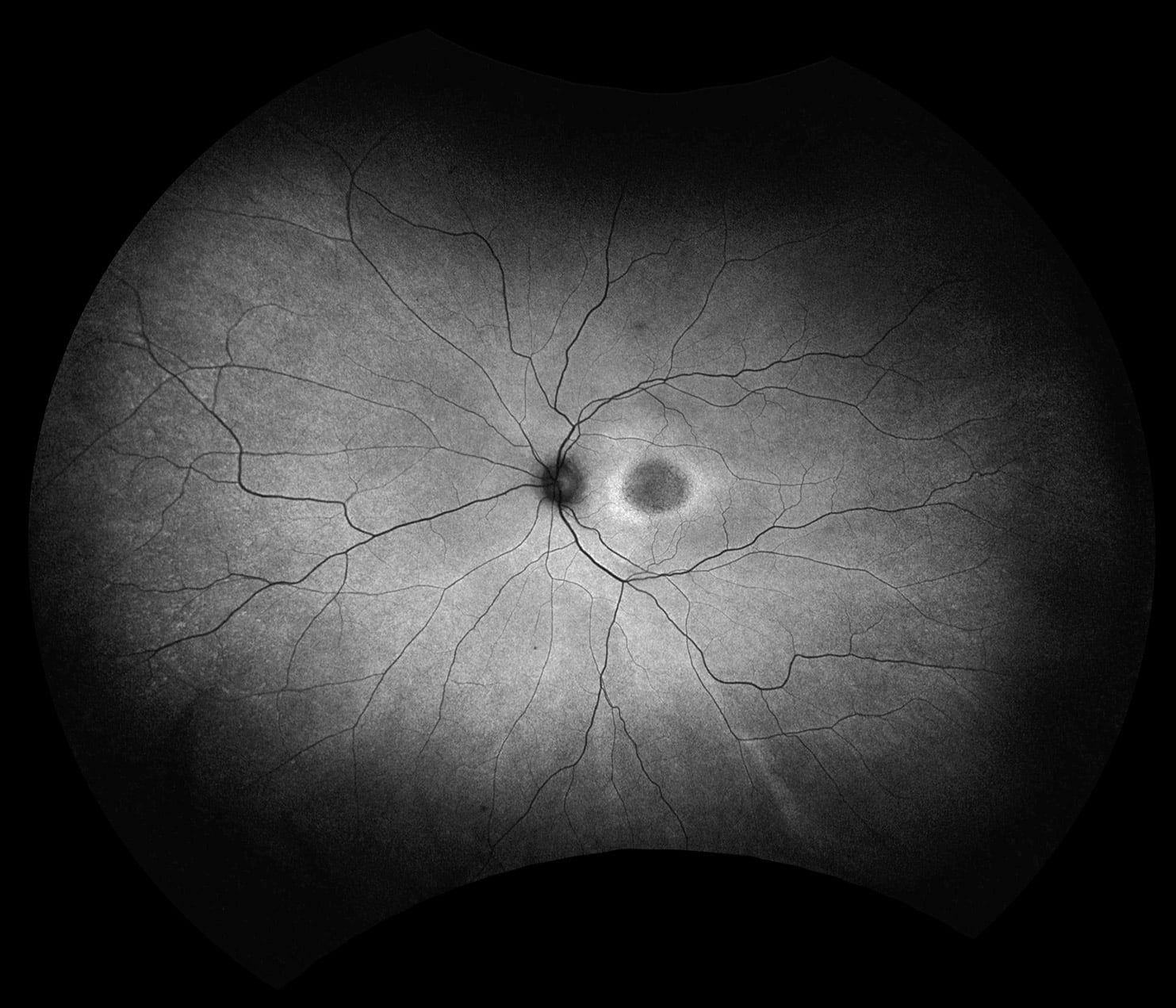 optomap green af Hydroxychloroquine Retinopathy