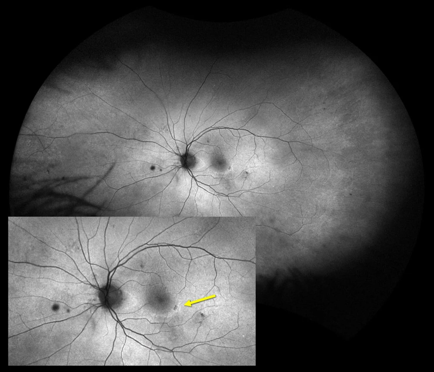 optmap green af Hydroxychloroquine Retinopathy