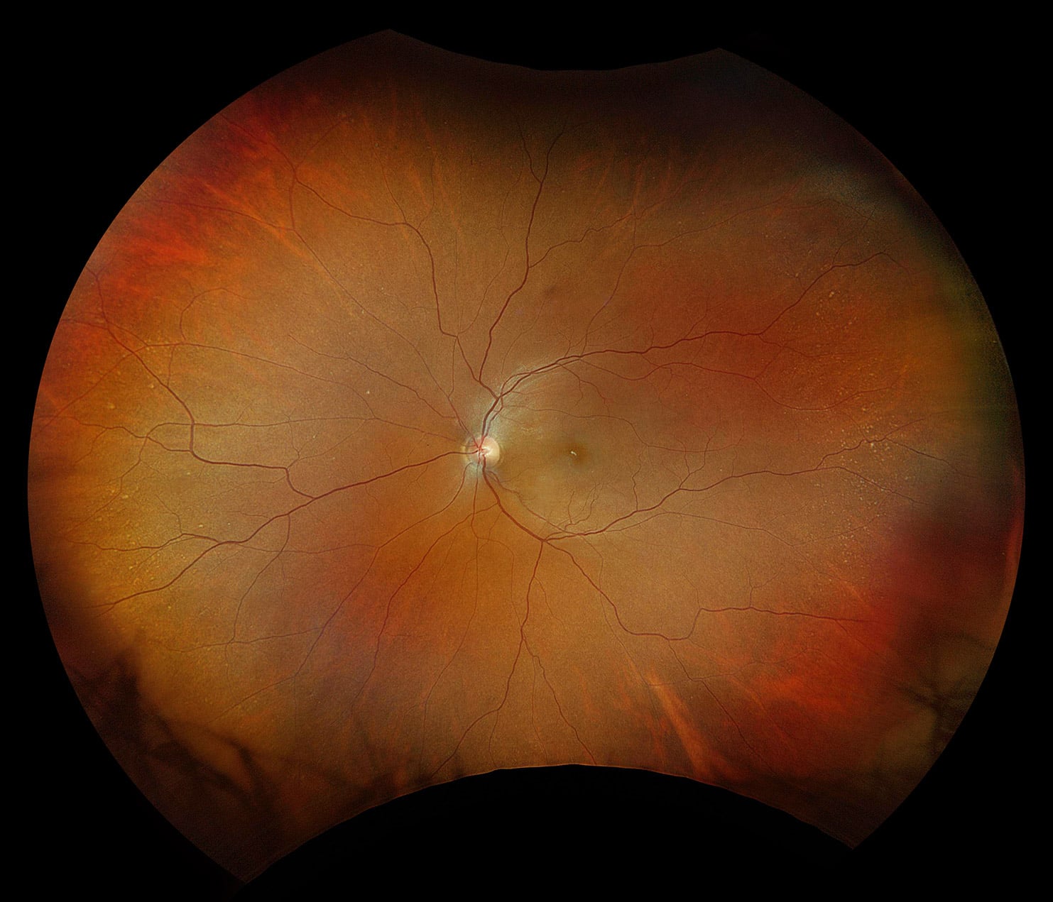 optomap color rgb Hydroxychloroquine Retinopathy