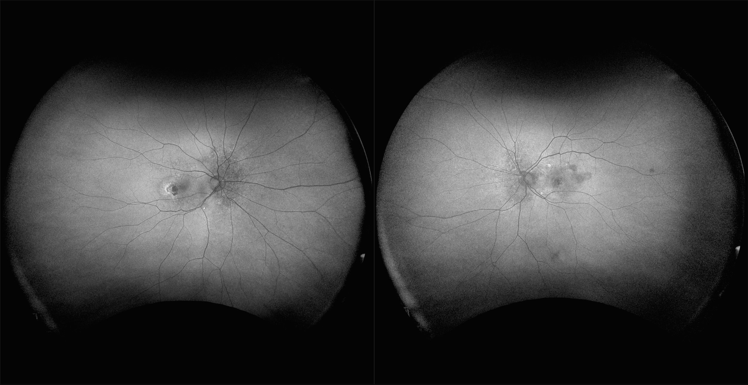 California - Neovascular AMD with Inactive CNV, AF