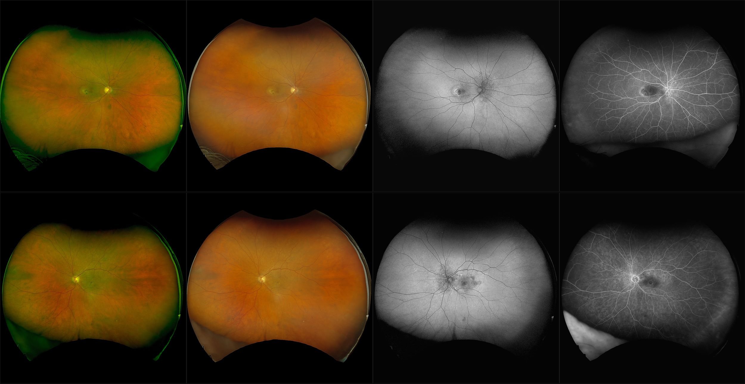 California - Neovascular AMD with Inactive CNV, RG, RGB, AF, FA