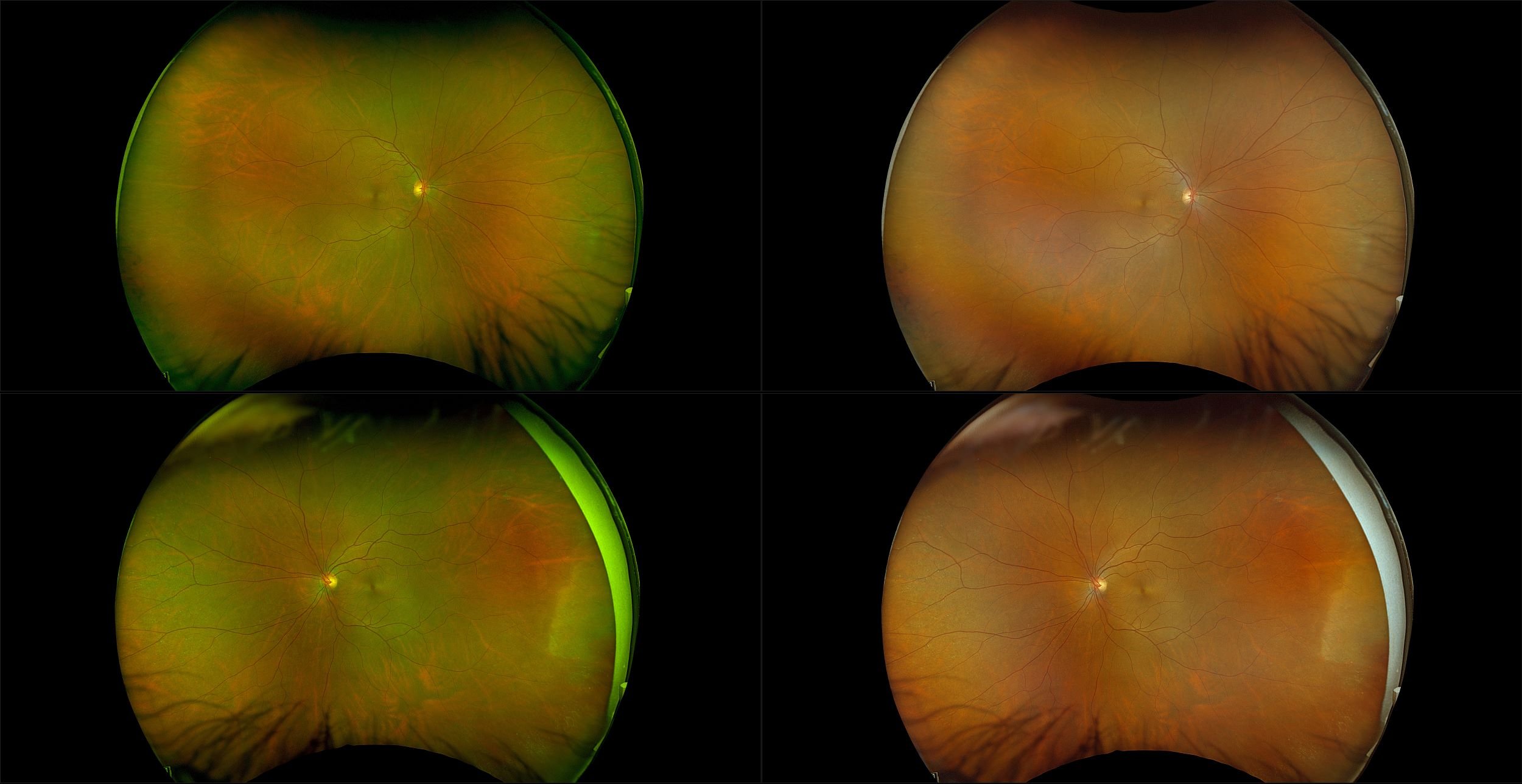 California - Diabetes Type 2 with no Ocular Complications, RG, RGB