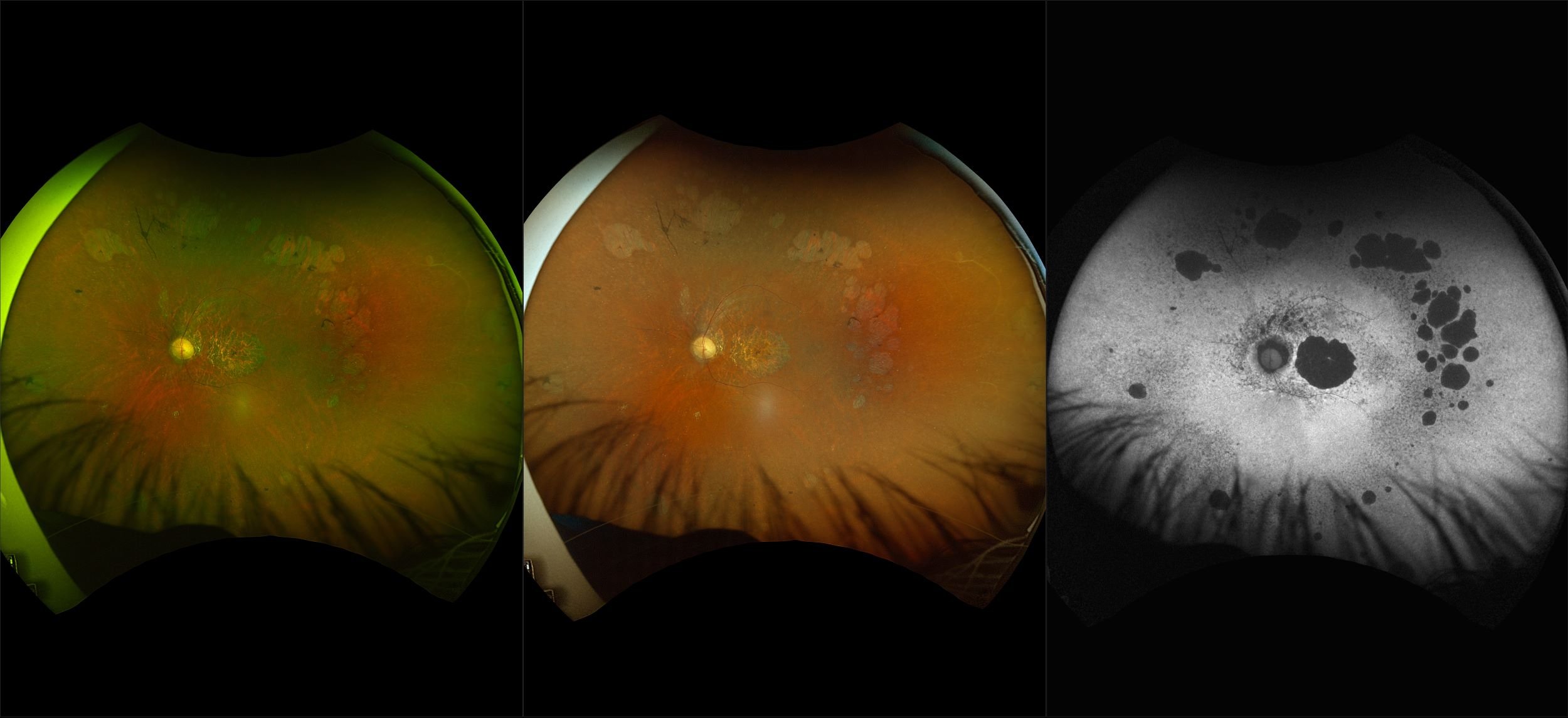 California - Dry AMD with Geographic Atrophy and Cobblestone Degeneration, RG, RGB, AF