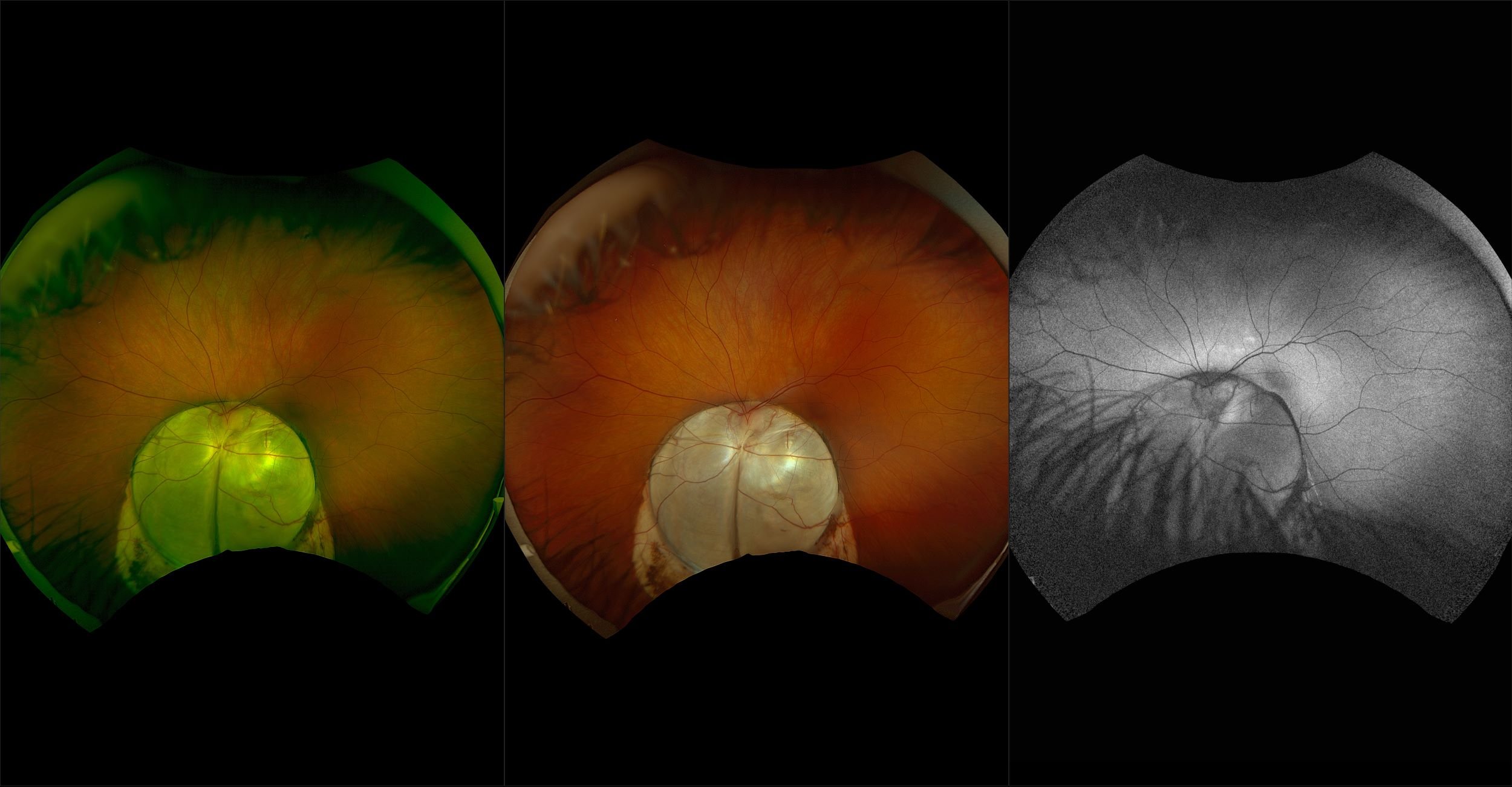 California - Optic Nerve Coloboma, RG, RGB, AF