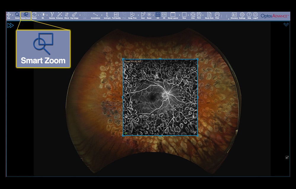 Using SmartZoom Overlay Feature