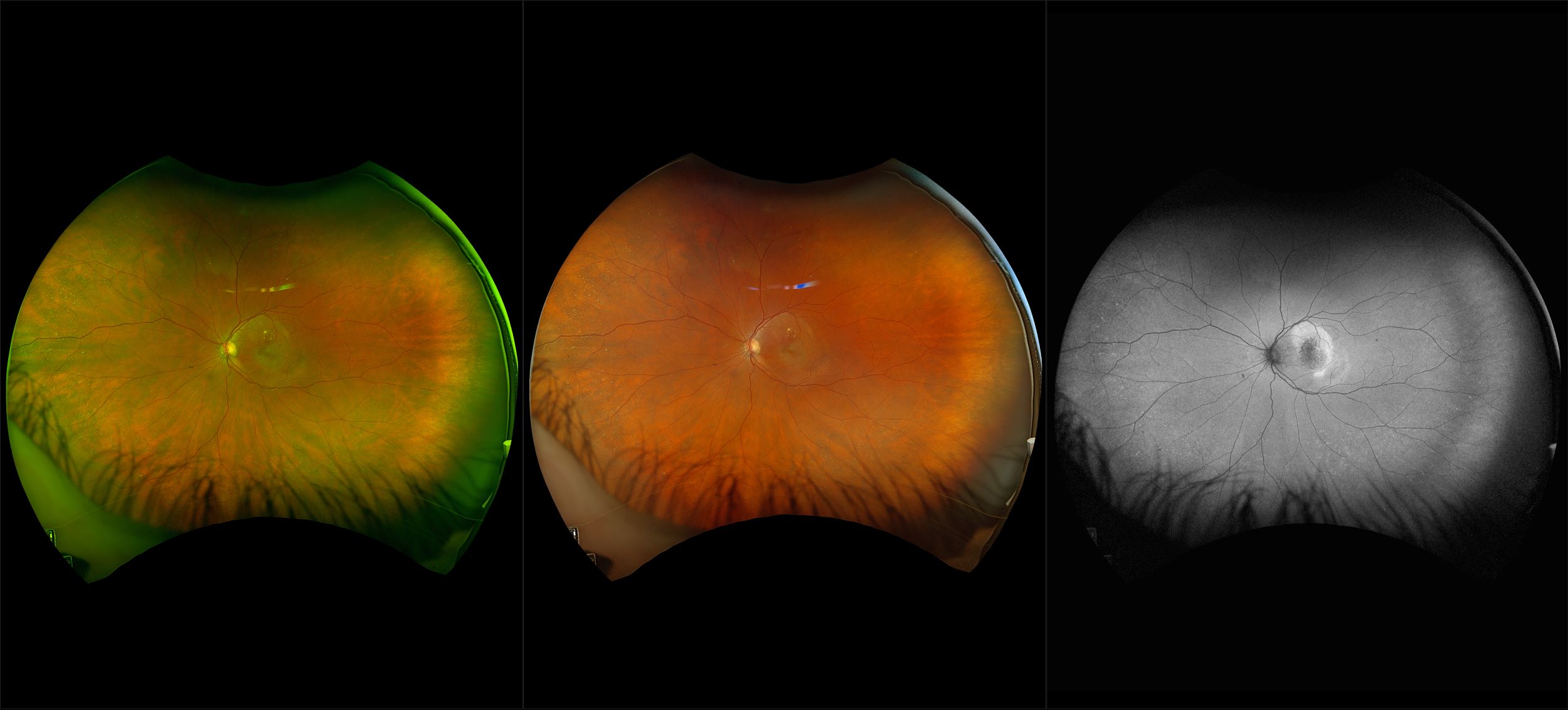 California - Wet AMD with Macular Edema, Subretinal Hemorrhage and SRF, RG, RGB, AF