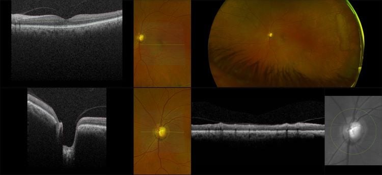 Monaco - Glaucoma with Deep Cup and Macular Pucker, RG, OCT