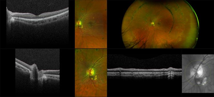 Monaco - Presumed Ocular Histoplasmosis Syndrome (POHS), RG, OCT