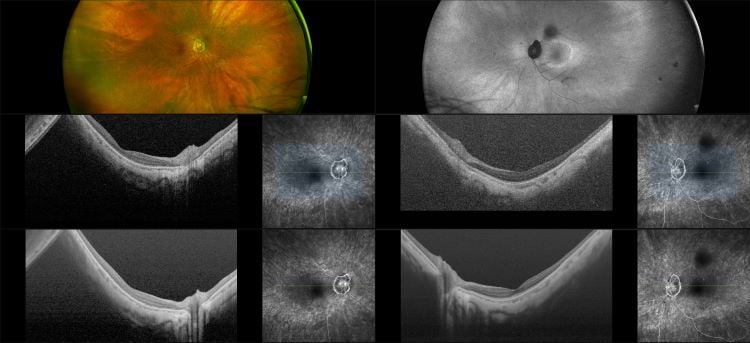 Silverstone - Retinal Dystrophy with High Myope, RG, AF, OCT