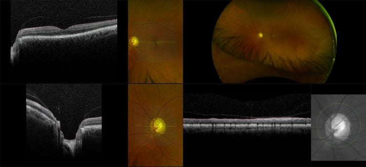 Monaco - Glaucoma with Superior Field Defect, RG, OCT