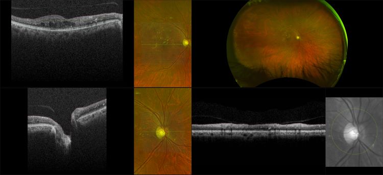 Monaco - Diabetic Retinopathy with DME and NVE, RG, OCT