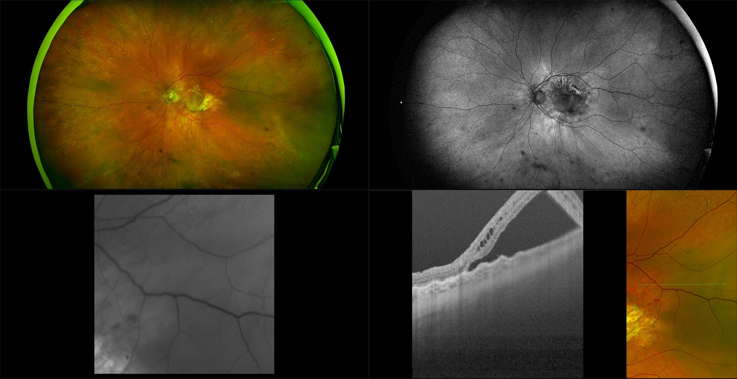 Silverstone - AMD with Retinal Detachment, RG, AF