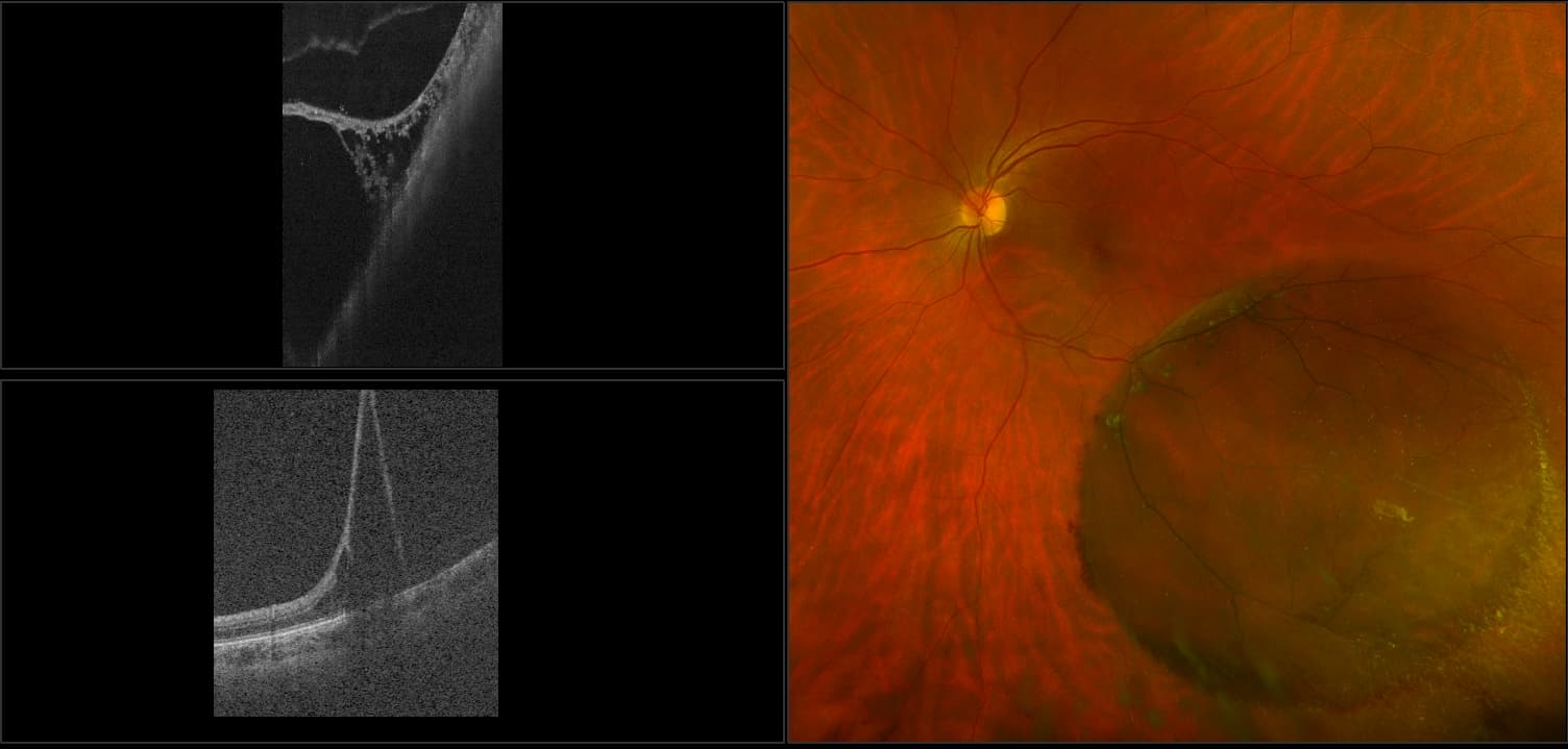 Silverstone - Atypical Retinal Schisis, RG, AF, OCT