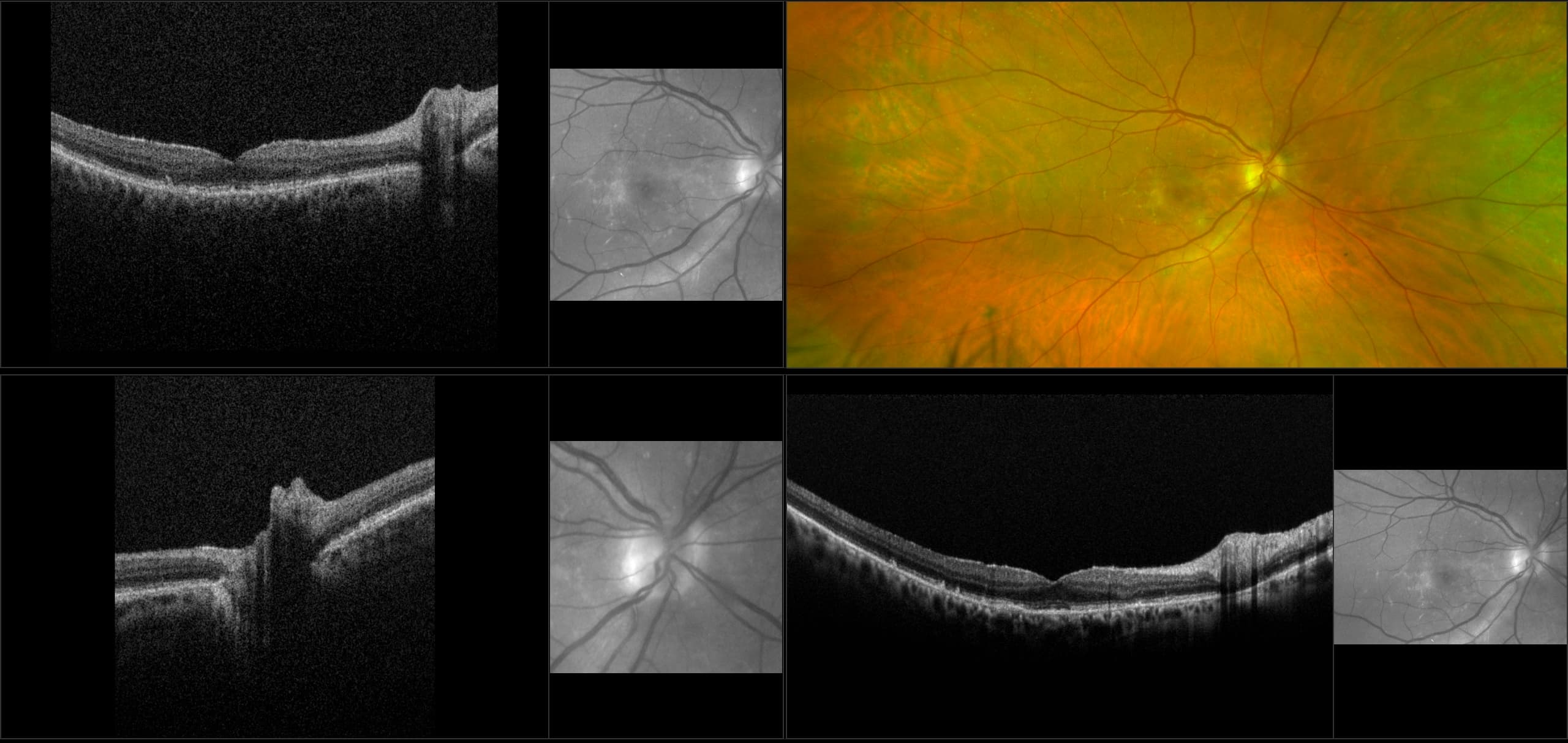 Monaco - Wet AMD with Drusen and PVD, RG, OCT