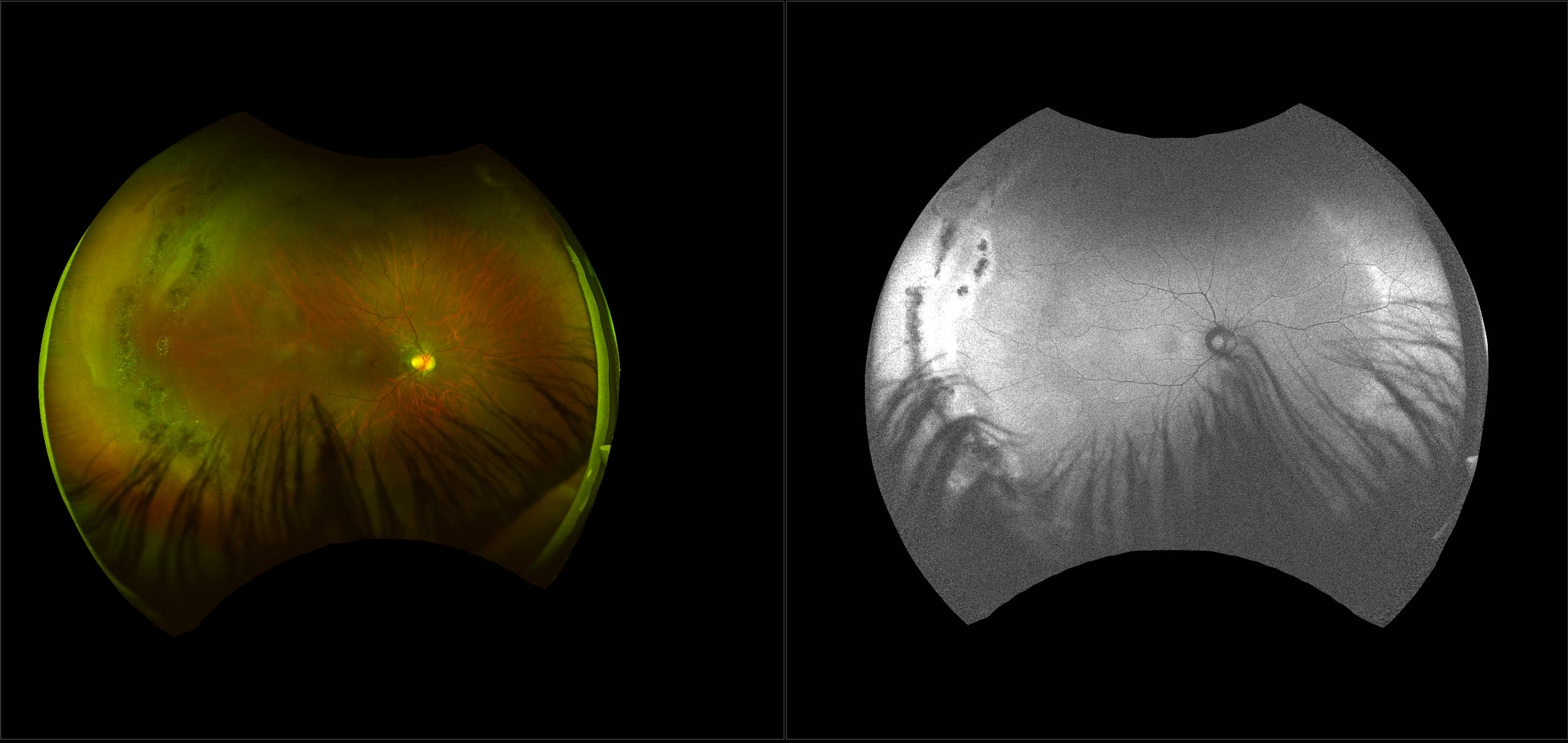 California - Peripheral Retinal Holes with Lattice Degeneration, RG, AF