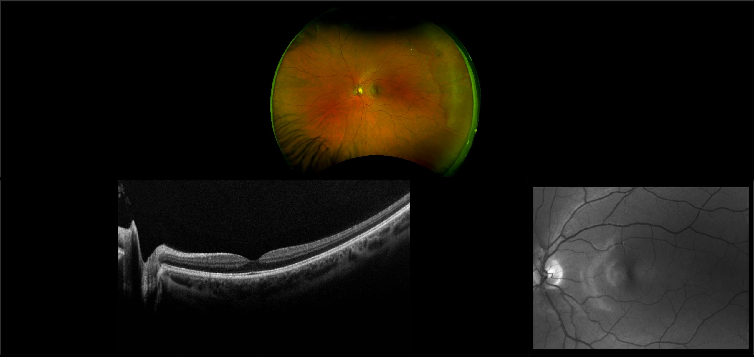 Monaco - Operculated Retinal Hole with White without Pressure (WWOP), RG, OCT