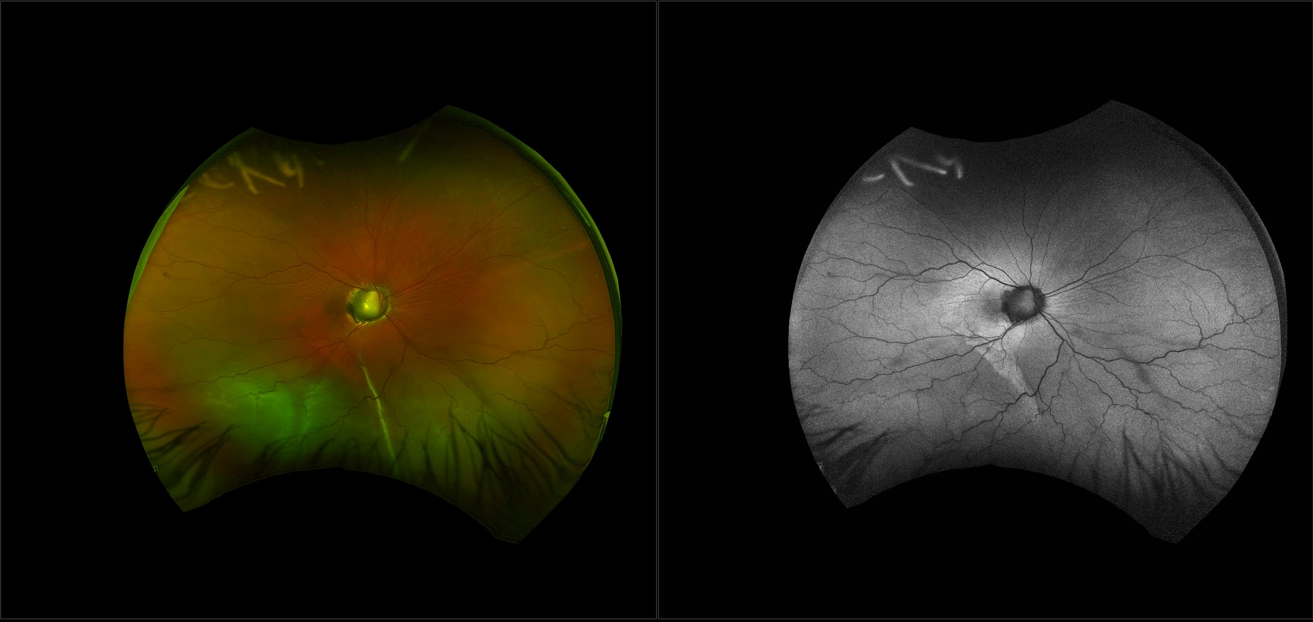 California - Morning Glory Disc Anomaly with Retinal Detachment, RG, AF
