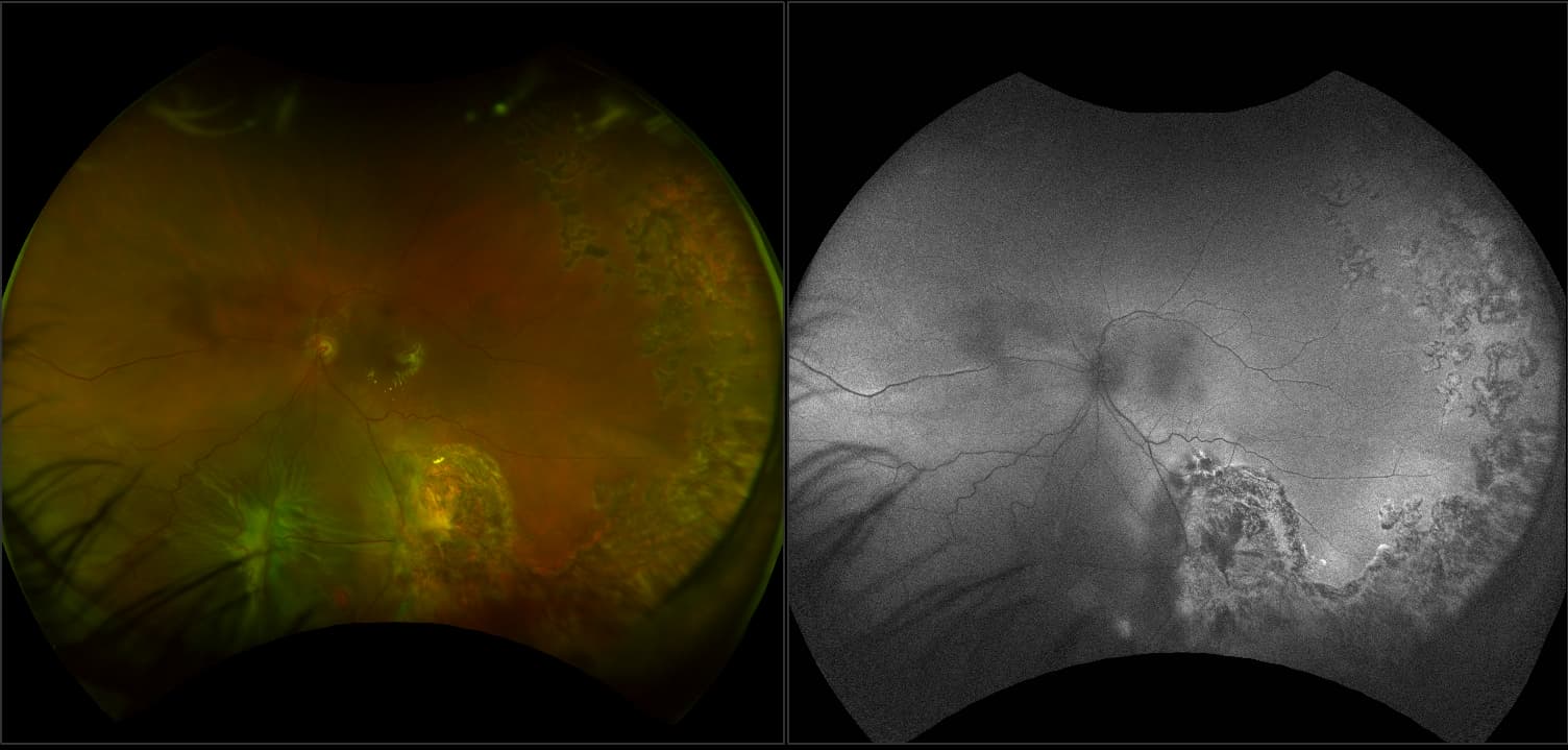 Monaco - Horseshoe Tear with Vitreous Floaters and Non-Proliferative Diabetic Retinopathy, RG, AF