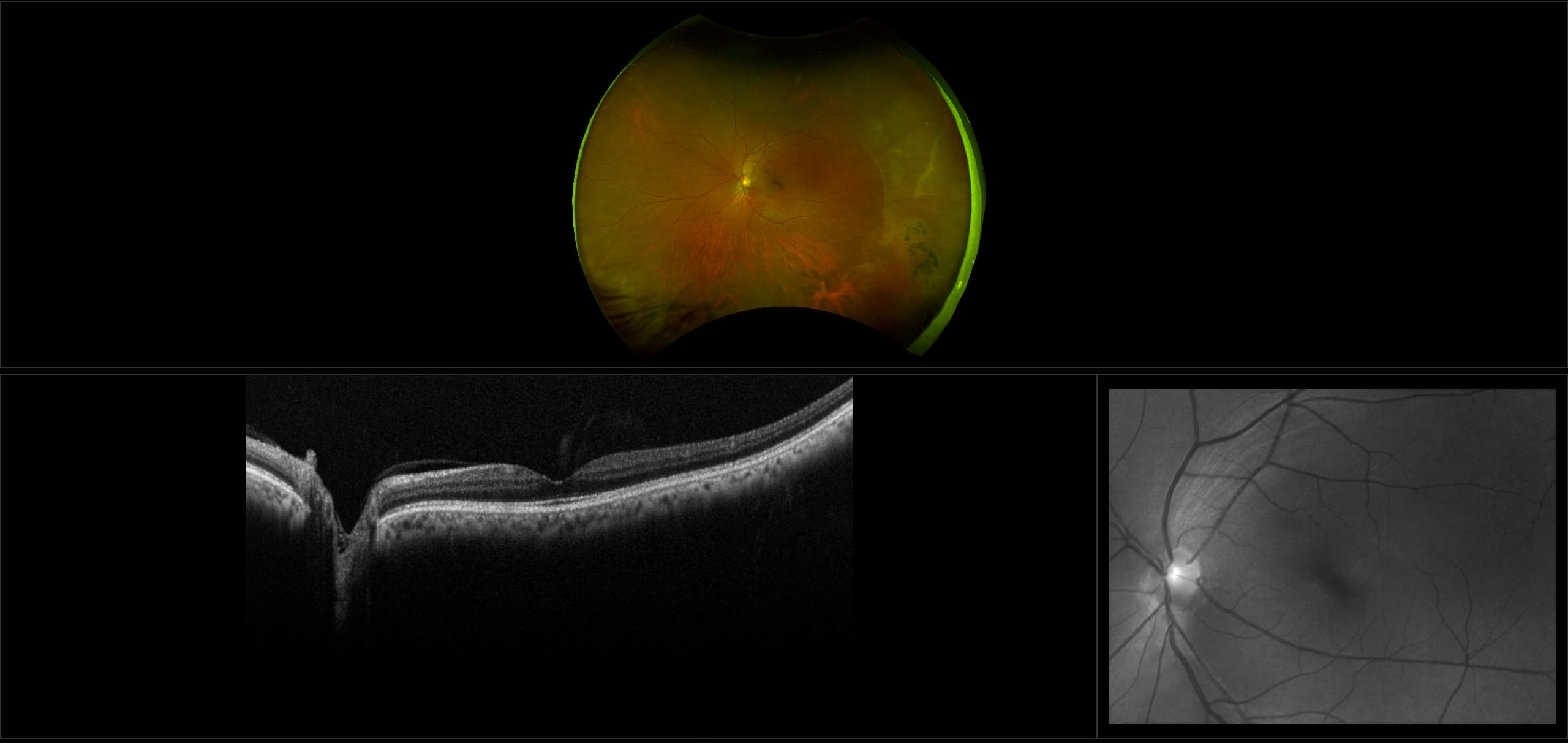 Monaco - Retinal Pigment Epithelium Hyperplasia with White without Pressure (WWOP), RG, OCT