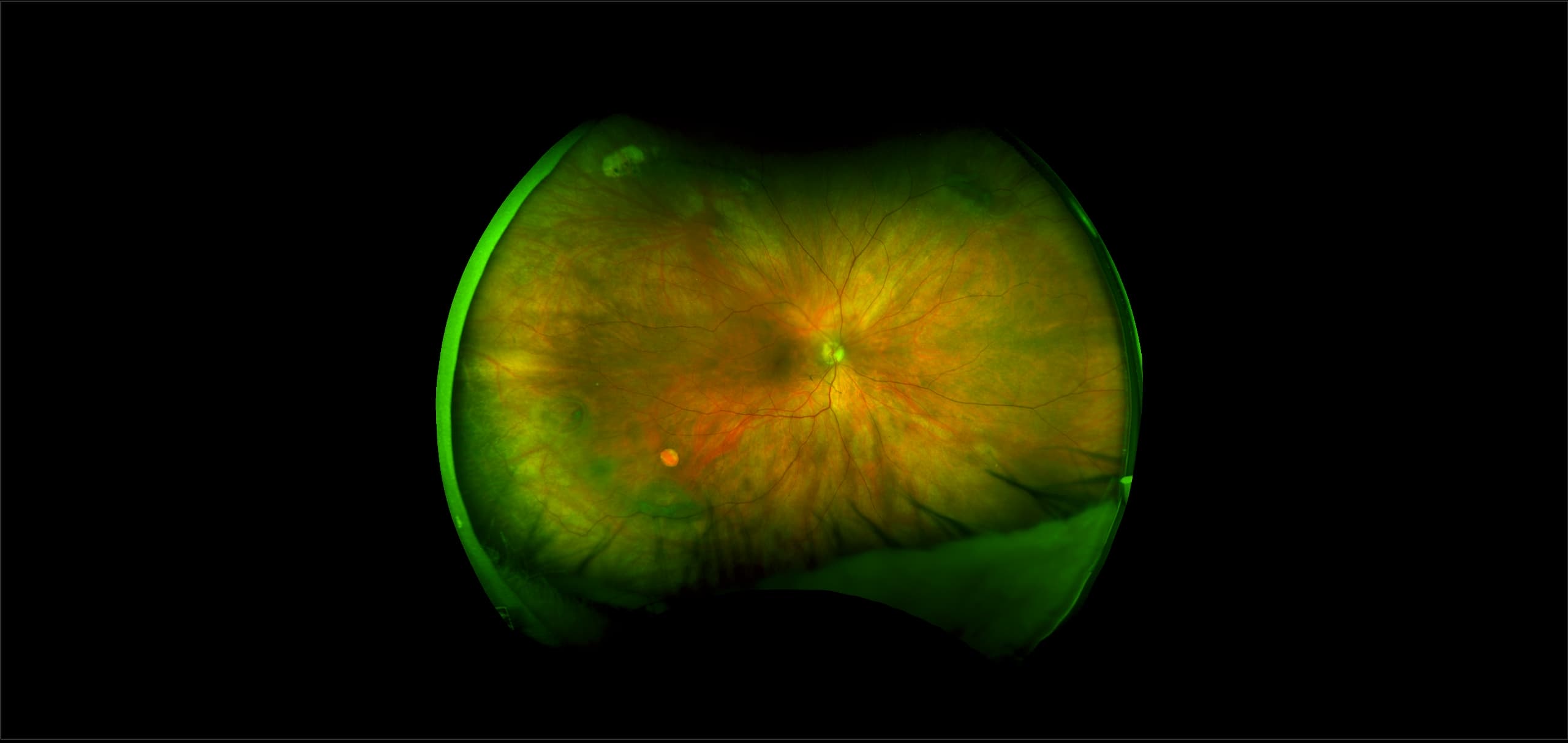 Retinal Hole - Case Study