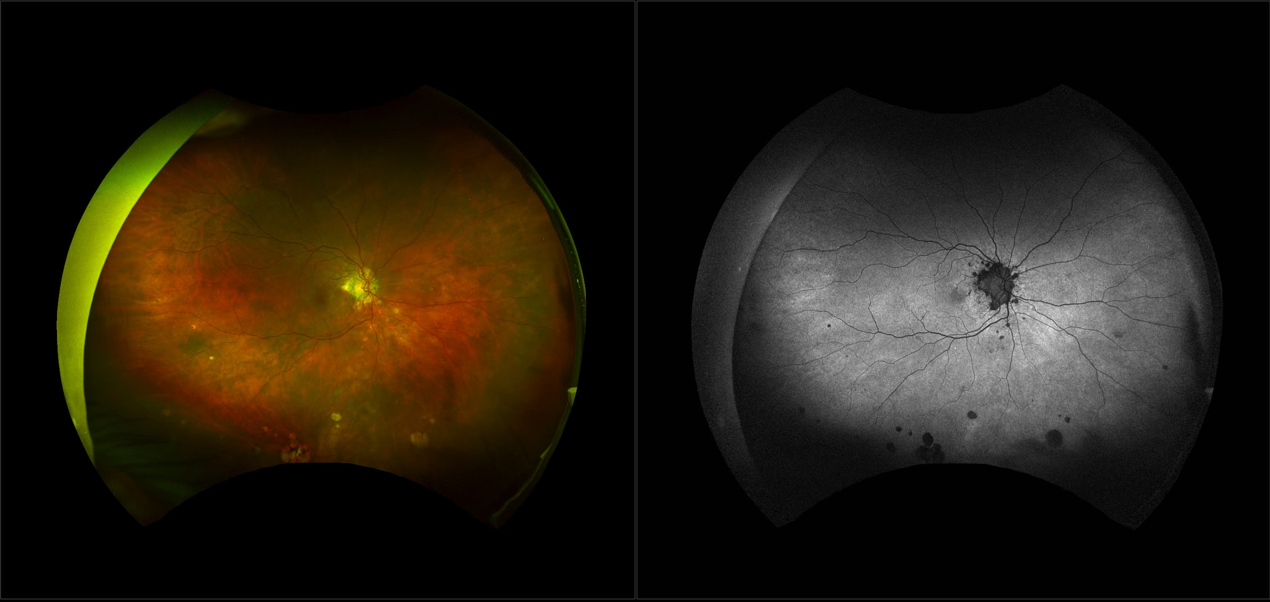 California - Posterior Uveitis with Vitreous Haze, RG, AF