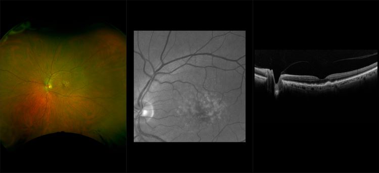 Monaco - Exudative Macular Degeneration with Cataract, RG, OCT