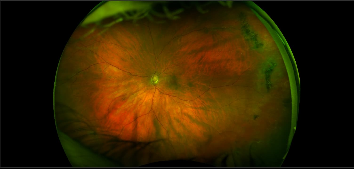 Monaco - Lattice Degeneration with Glaucoma, RG