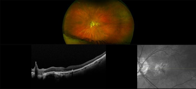 Monaco - Dry AMD with IOL and ERM, RG, OCT