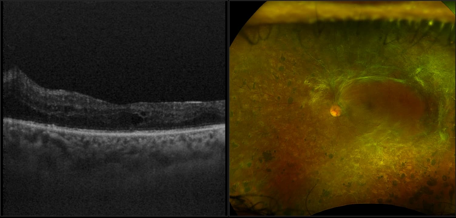 Silverstone - Active Prolific Diabetic Retinopathy with DME, RG, AF, OCT