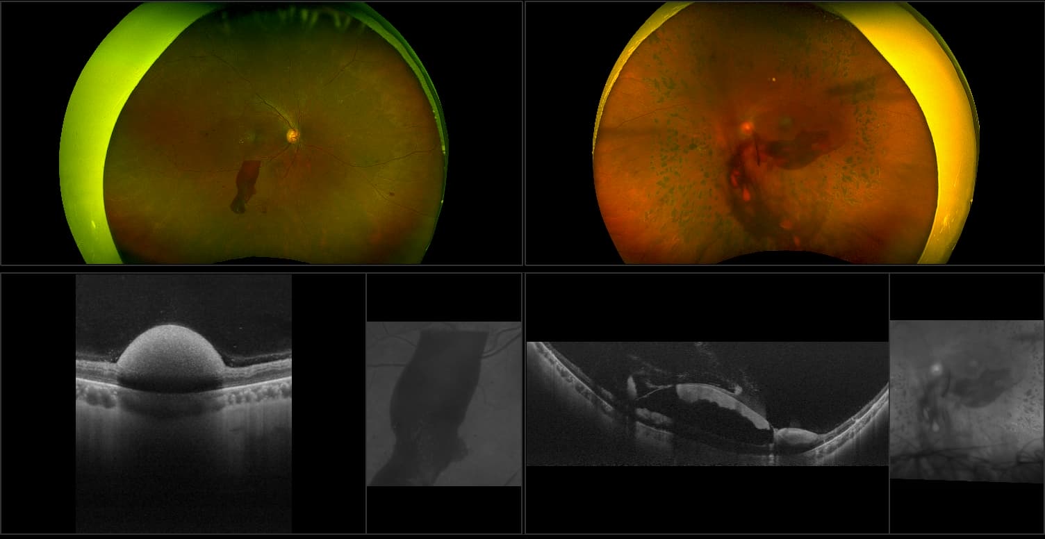 Silverstone - Diabetic Macular Edema, Active PDR, RG, AF, OCT