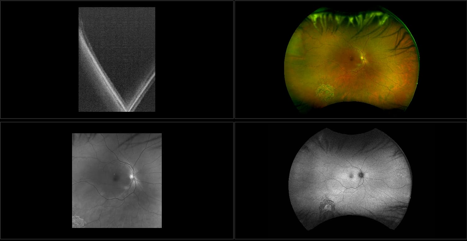 Silverstone - Treated Operculated Retinal Hole with Retinoschisis and White without Pressure (WWOP), RG, AF, OCT