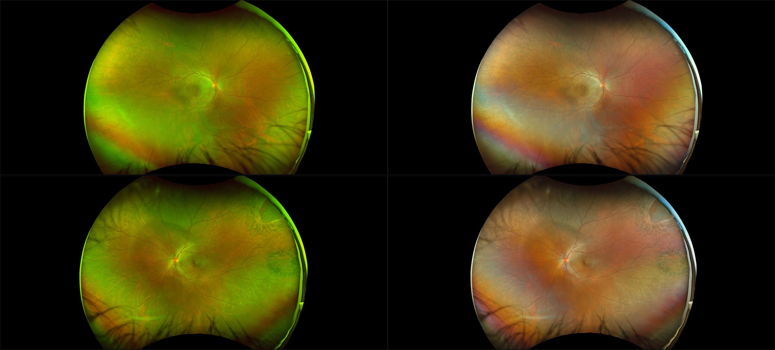 California - Retinal Tear with Posterior Uveitis, RG, RGB