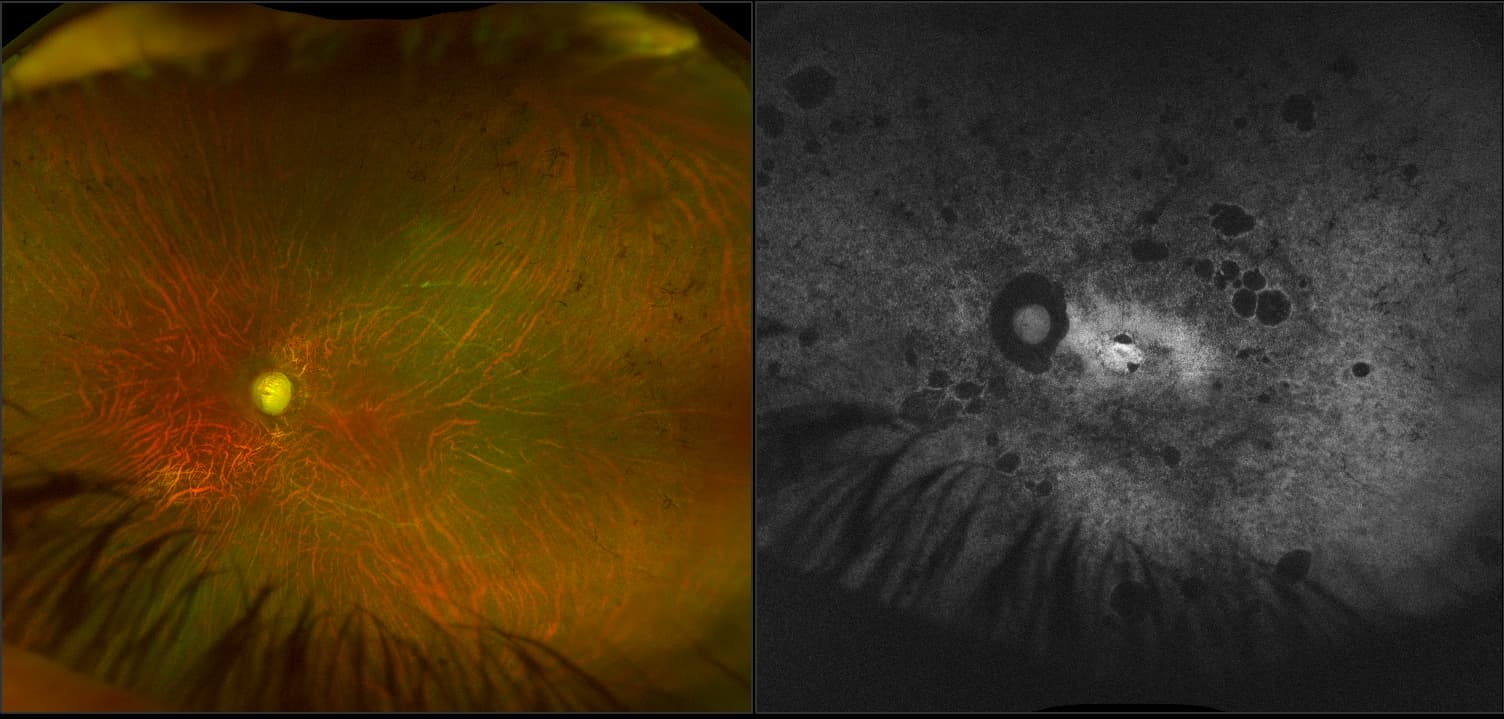 California - Uveitic Glaucoma, RG, AF, Stereo