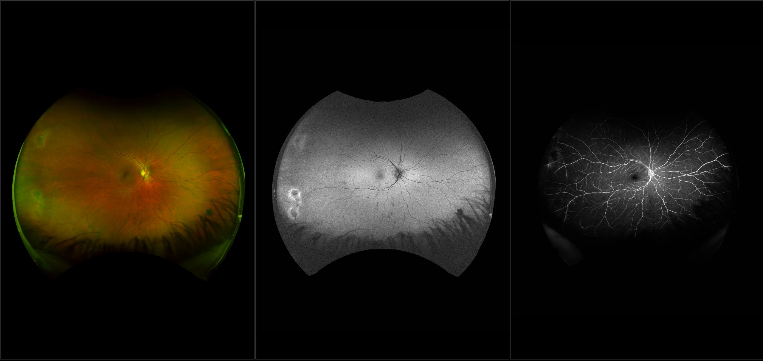 California - Retinal Hole, Horseshoe Tear, RG, AF, FA