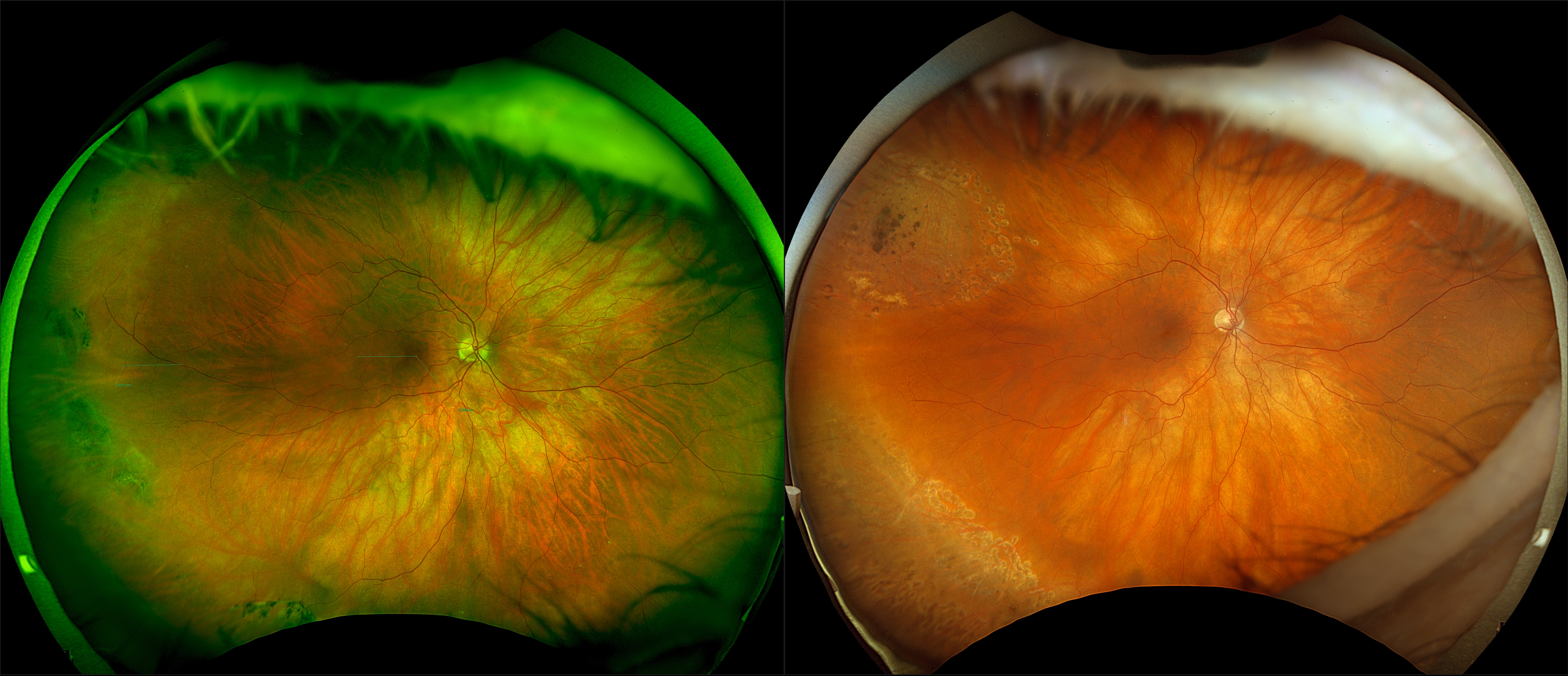 California - Peripheral Retinal Degeneration, RG, RGB