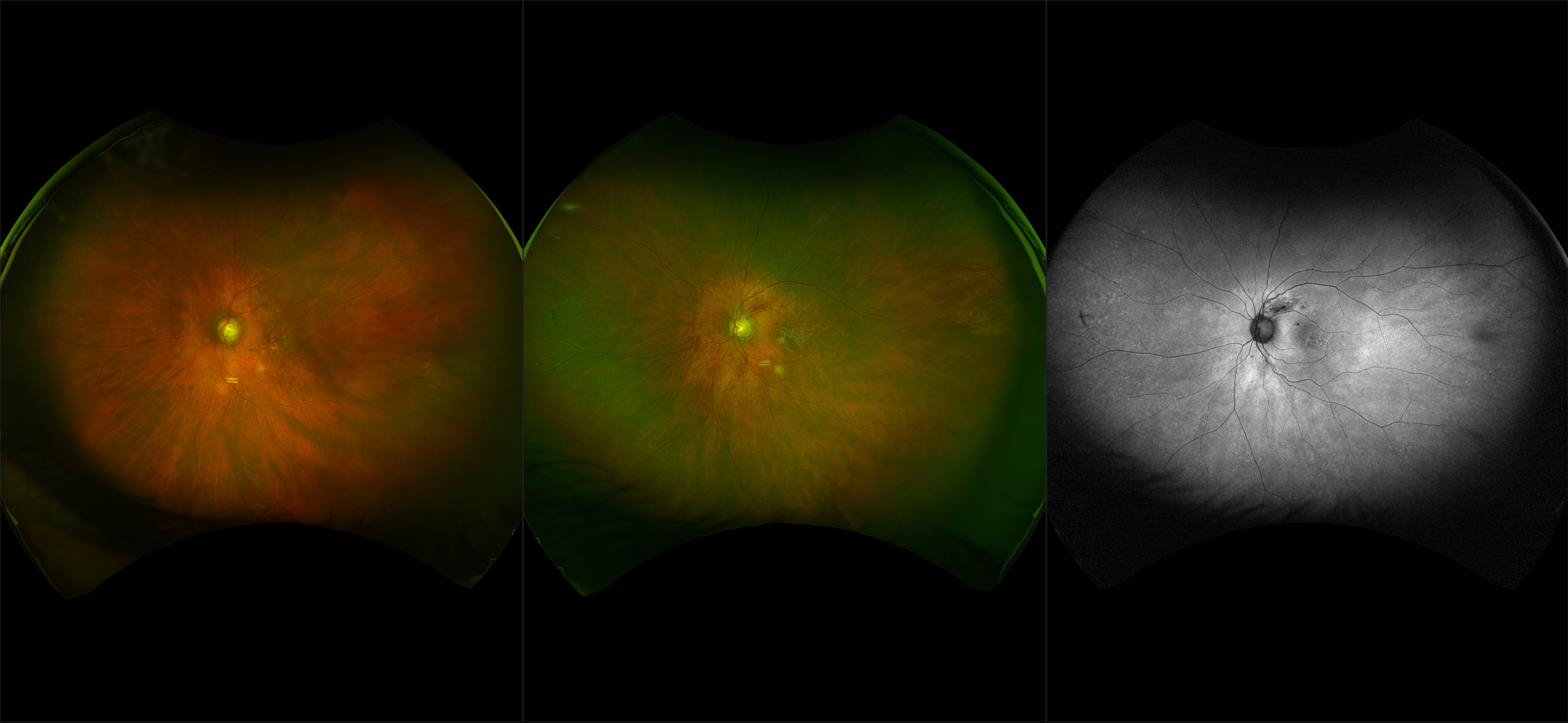 California - Central Retinal Vein Occlusion (CRVO) with CME, RG, RGB, AF