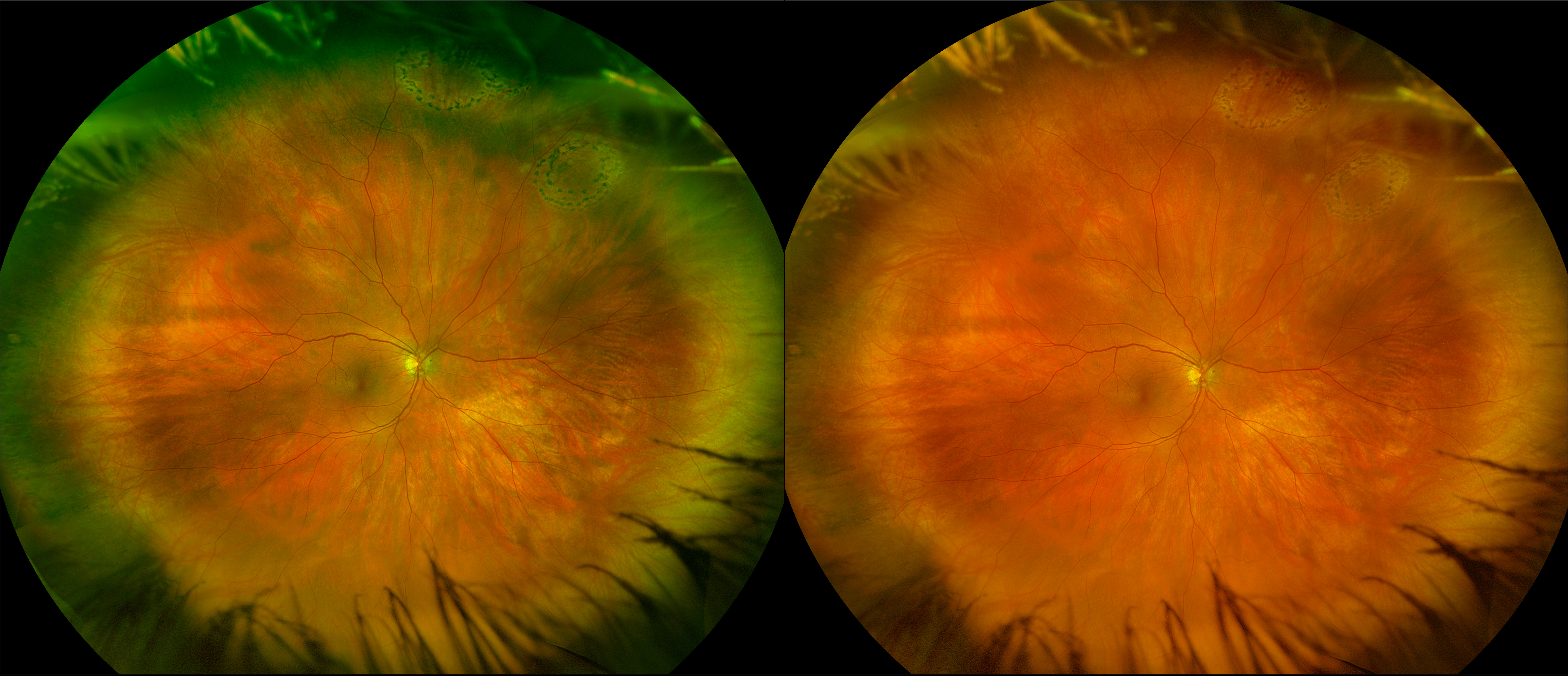 California - Treated Retinal Holes, RG, RGB