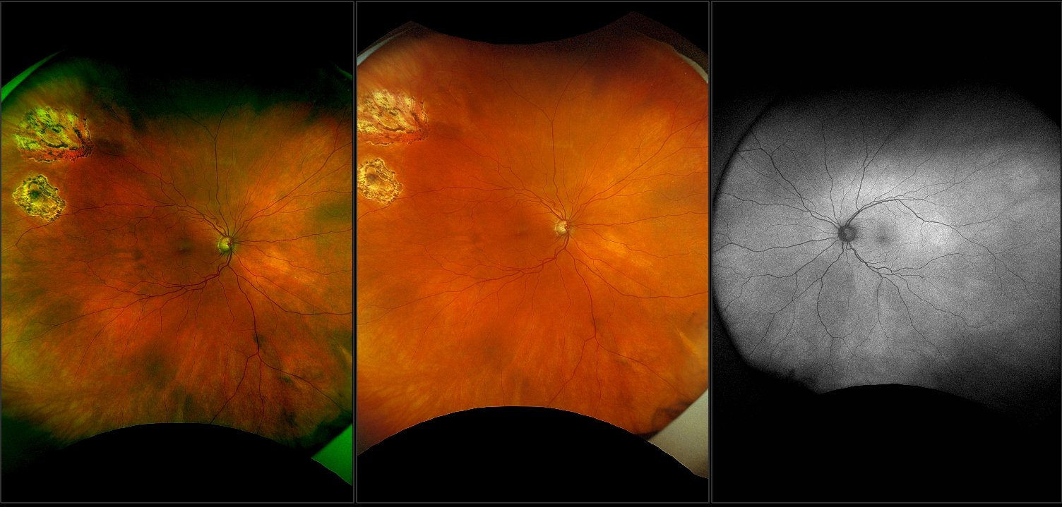 California - Primary Open Angle Glaucoma and Repaired Mac-on RD, RG, AF, RGB
