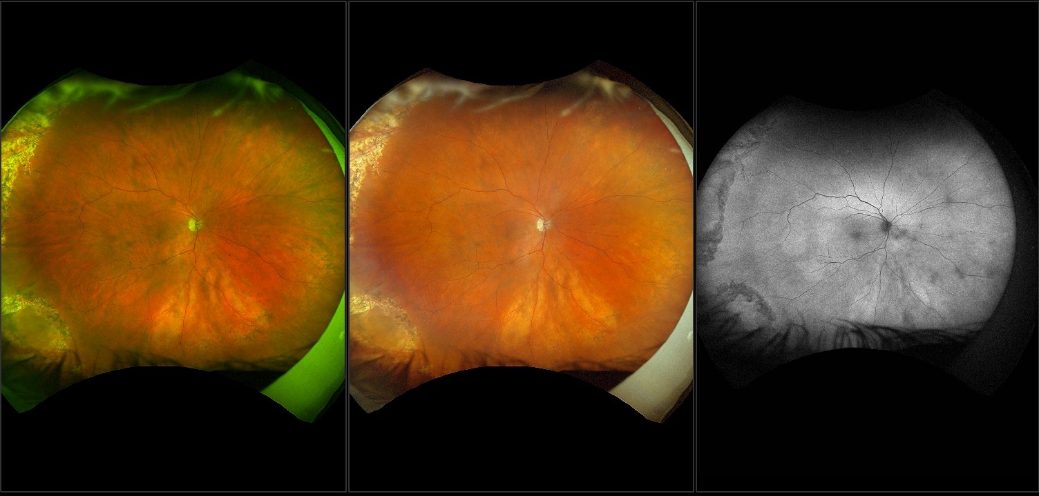 California - Repaired Recurrent Retinal Detachment with PVR, RG, AF, RGB
