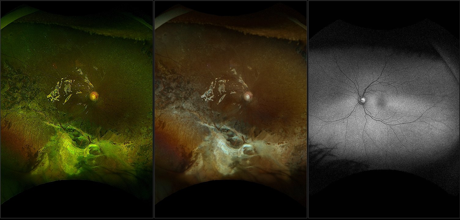 California - Acute Retinal Necrosis with Repaired RD, PVR, CME and Silicone Oil, RG RGB, AF