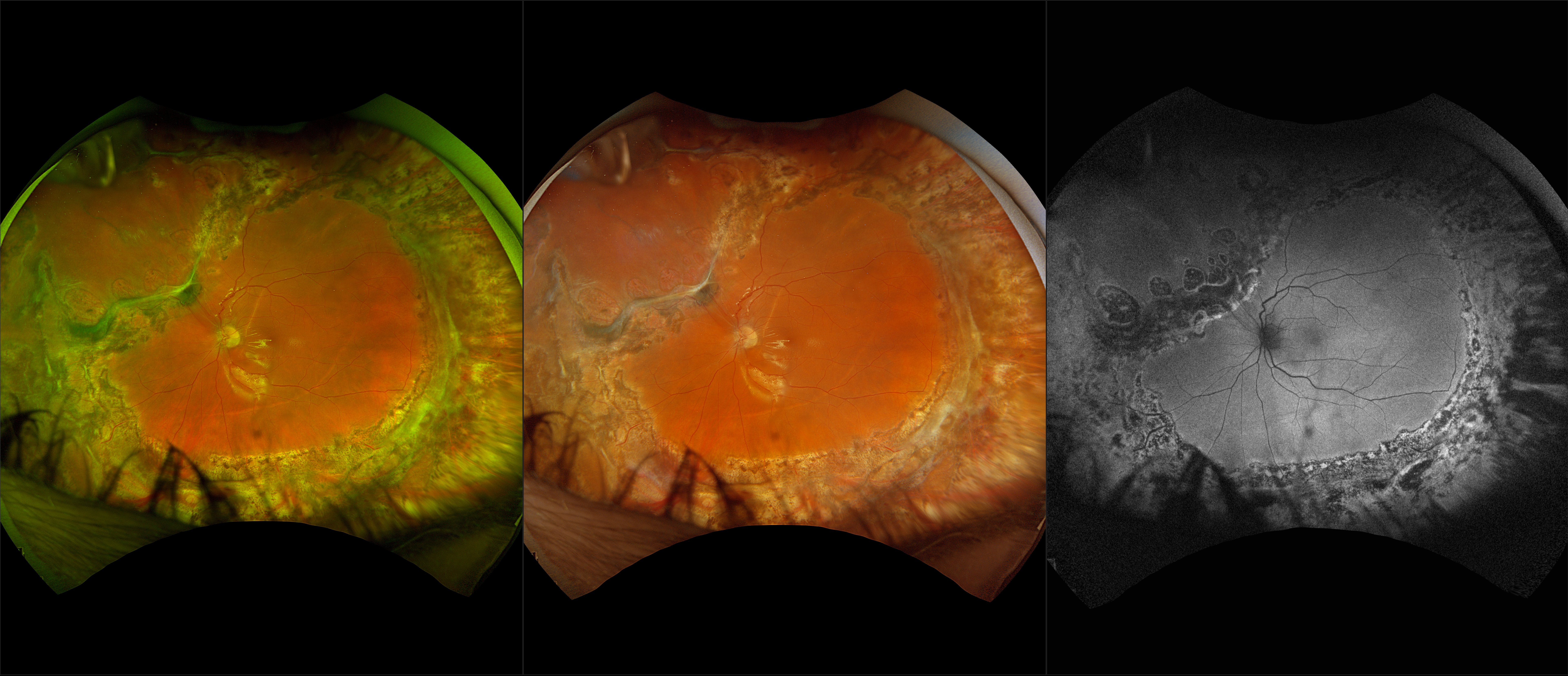 California - Repaired Retinal Detachment, RG, RGB, AF