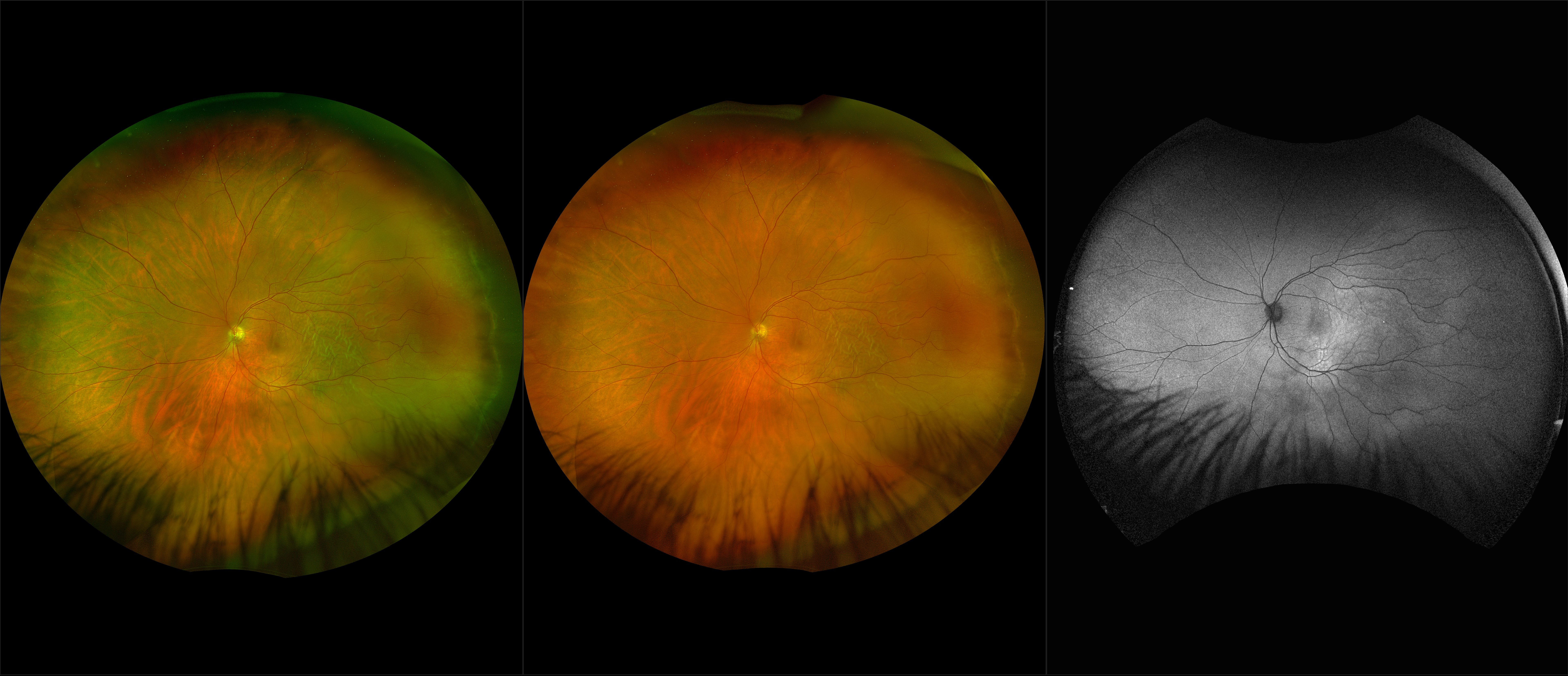 California - Retinal Detachment, RG, RGB, AF