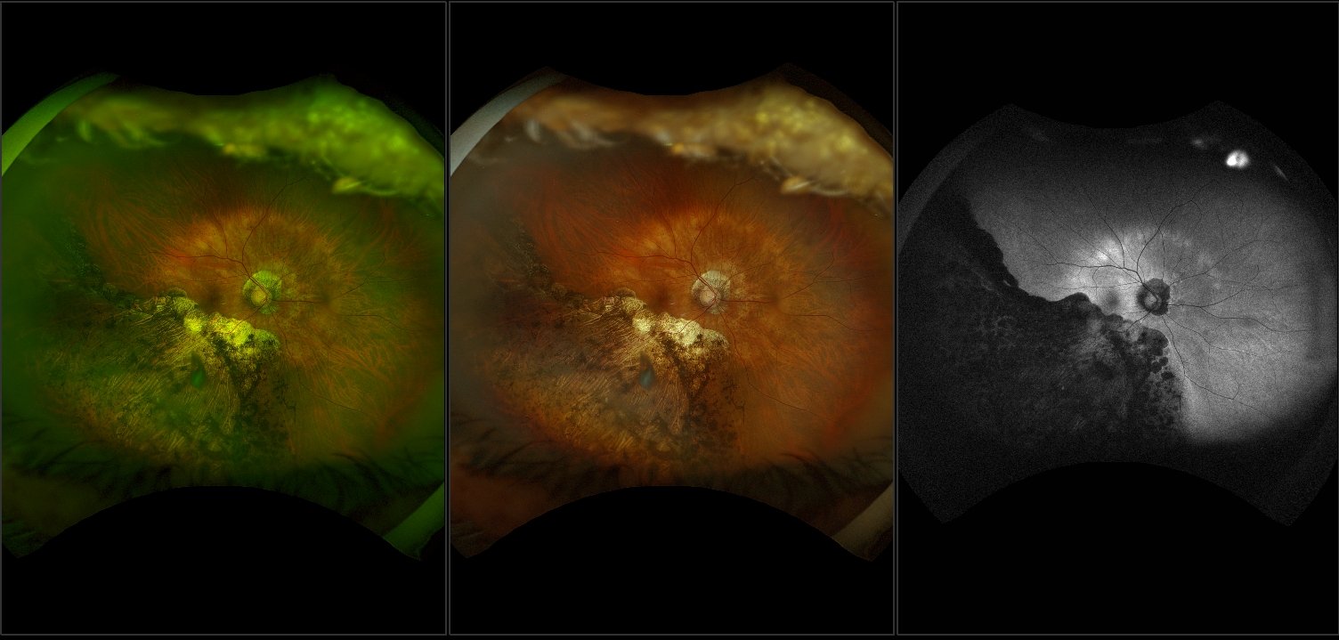 California - Peripapillary Atrophy with Chronic Partial Retinal Detachment and Atrophic Retinal Hole, RG, AF, RGB